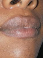 After Lip Correction