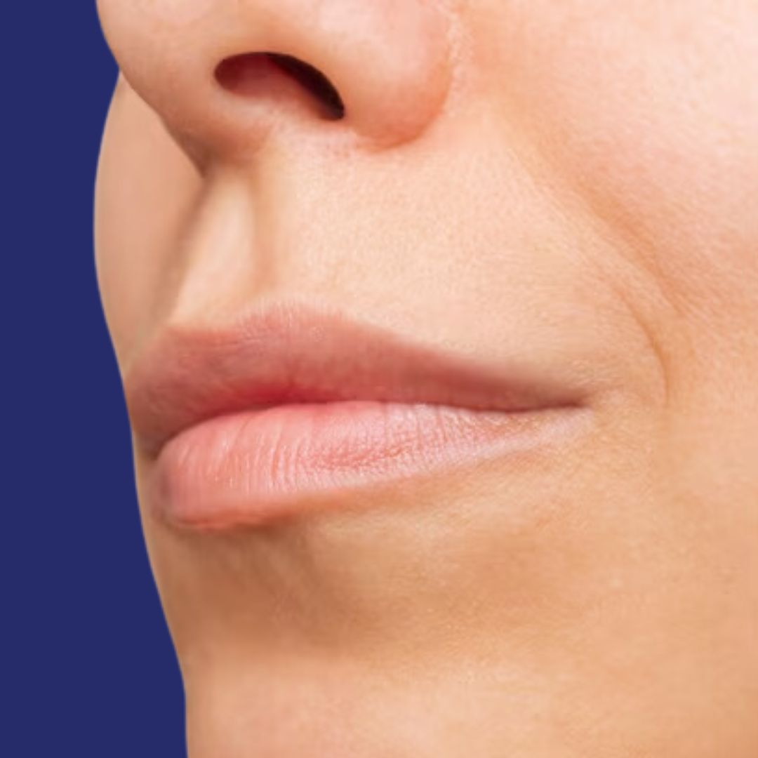 Profile photograph of the face before lipfiller