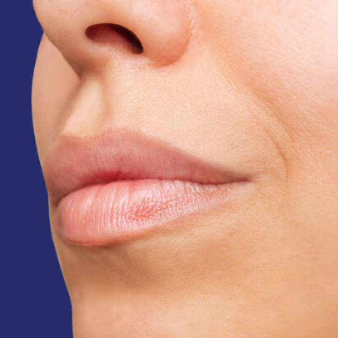 Profile view of face post-lipfiller